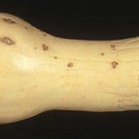 Antracnose