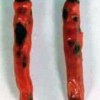 Antracnose