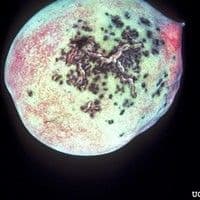 Mancha bacteriana
